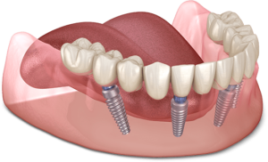 Dental-Implant-Mouth-Model