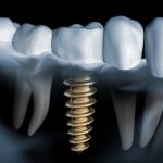 Dental implants require cleaning to prevent bacteria from causing bone loss.