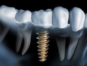 Dental implants require cleaning to prevent bacteria from causing bone loss.