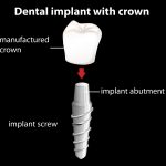 Our Mountain View, CA patients know that dental implants provide amazing replacement teeth that fulfill their needs.