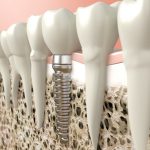 In Mountain View, CA, our patients know that dental implants are a great alternative to dentures.