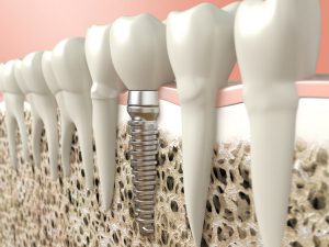 In Mountain View, CA, our patients know that dental implants are a great alternative to dentures.