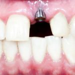 Dental implants provide permanent oral function.