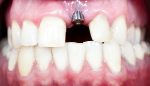 Dental implants provide permanent oral function.