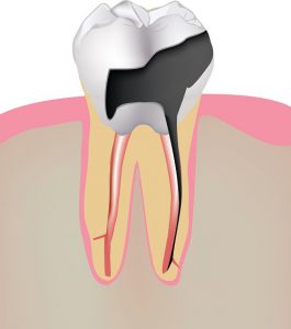 Our Mountain View, CA area patients know that tooth decay can result in missing teeth, which should be treated with dental implants.