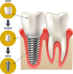 Dental Implant Infographic MountainView