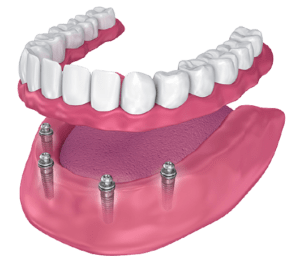 all-on-4 dental implants