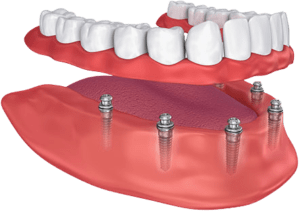 all-on-6 dental implants