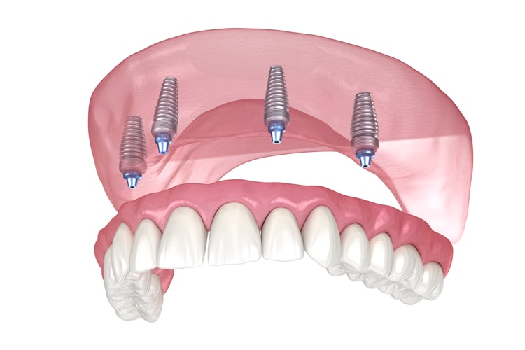 ImplantSupported Dentures Mountain View Cupertino CA