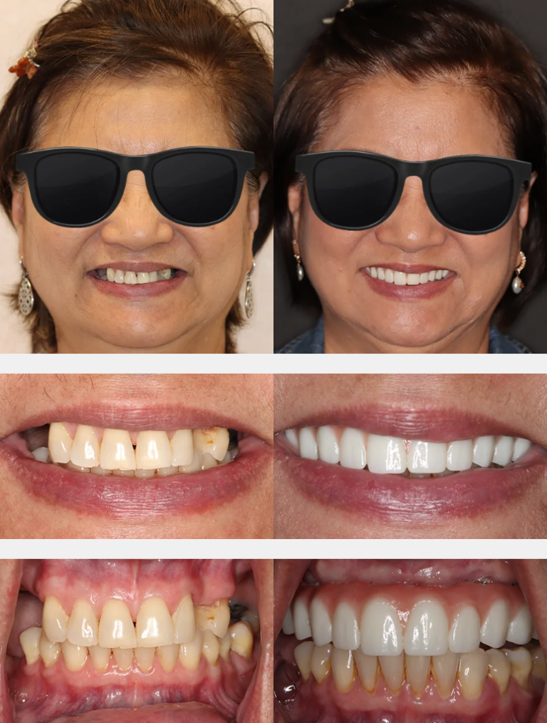 Cost of Dental Implants in Mountain View Cupertino CA